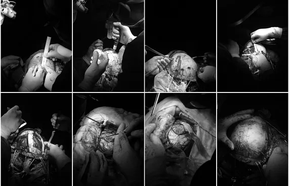 އޭޑީކޭގައި ސިކުނޑީގެ ބޮޑު އޮޕަރޭޝަނެއް ކޮށްފި