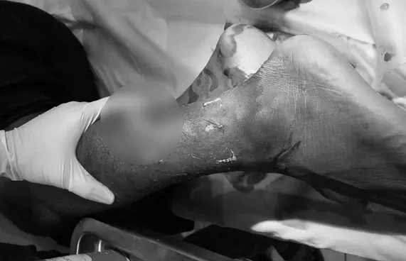 މިޔަރެއްގެ ހަމަލާގައި ޓޫރިސްޓަކު ޒަހަމްވެ،ފައިބުރިކޮށްލައިފި