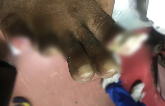 މިނިވަންކުރި މީހެއްގެ އިނގިލިތައް ބުރިކޮށްލަން ޖެހިއްޖެ