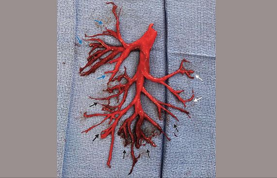 ކެއްސާލި ތަނުން އަނގަޔަށް އައީ ފުއްޕާމޭގެ ތަންގަނޑެއް