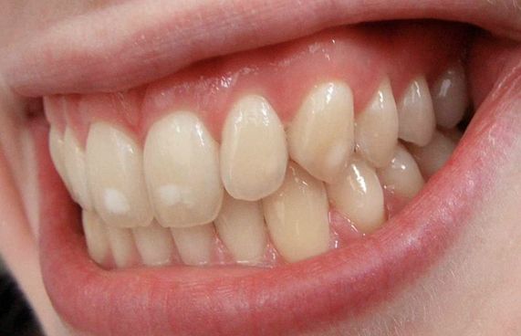 ދަތް އުނގުޅާ ބޭސް މާގިނައިން ބޭނުންކުރާތީ ގެއްލުންވޭ