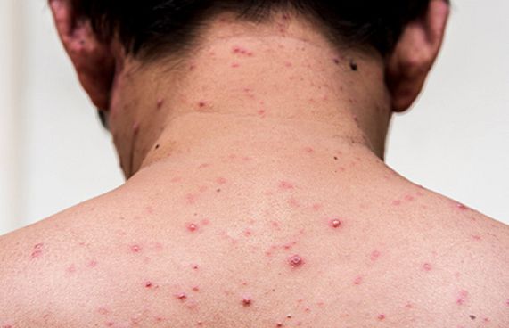 ހިމަބިހި ޖެހިފައިވާ މީހަކު އަނެއްކާ ވެސް ފެނިއްޖެ