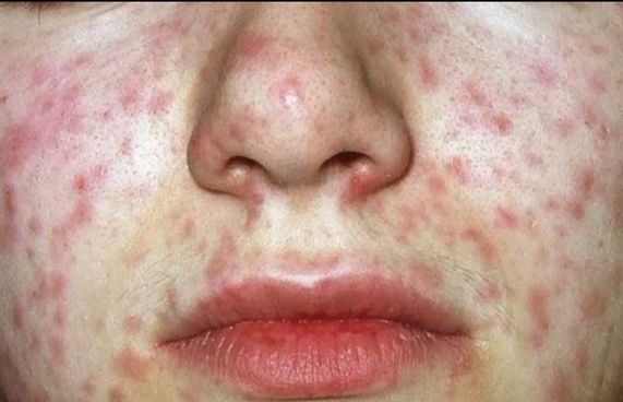 ހިމަބިހި ޖެހިފައިވާ ދެ މީހަކު އަނެއްކާ ވެސް ފެނިއްޖެ