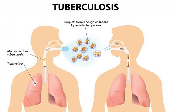 ކޮވިޑް-19 އަށް ފޯކަސް ހުއްޓި، ޓީބީ އިތުރުވެދާނެ