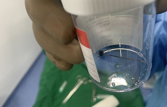 11 އަހަރުގެ ކުއްޖެއްގެ ފުއްޕާމެއިން ޕިނެއް ނަގައިފި