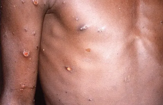 އެއްޖިންސުން ގުޅުން ހިންގާ މީހުންގެ ތެރޭ މަންކީޕޮކްސް