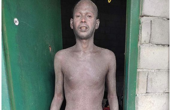 ޒުވާން އުމުރުގައި ހަމުގެ ބައްޔަކުން ބަލި އެނދަށް