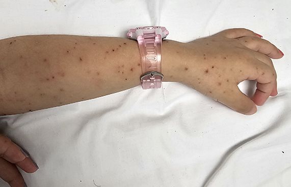 މެނިންގޯކޮކަލް ބަލީގެ އިތުރު ޕޮޒިޓިވް މީހަކު ނެތް