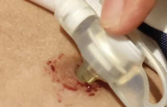 ފީޑިން ޓިއުބް ނުލިބި 8 މަސް، ކުއްޖަކު މަރުވި މައްސަލަ ބަލަނީ