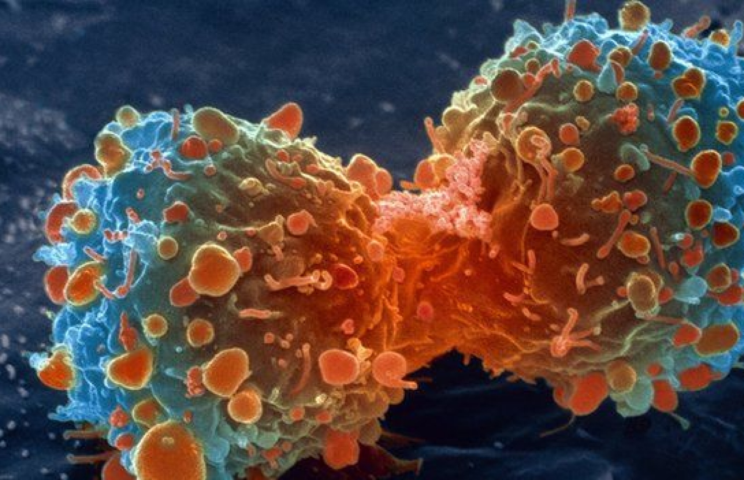 ކެންސަ ސެލް އެއް: ރާއްޖޭގައި މި ބަލި ޖެހޭ މީހުންގެ އަދަދު އަންނަނީ އިތުރުވަމުން