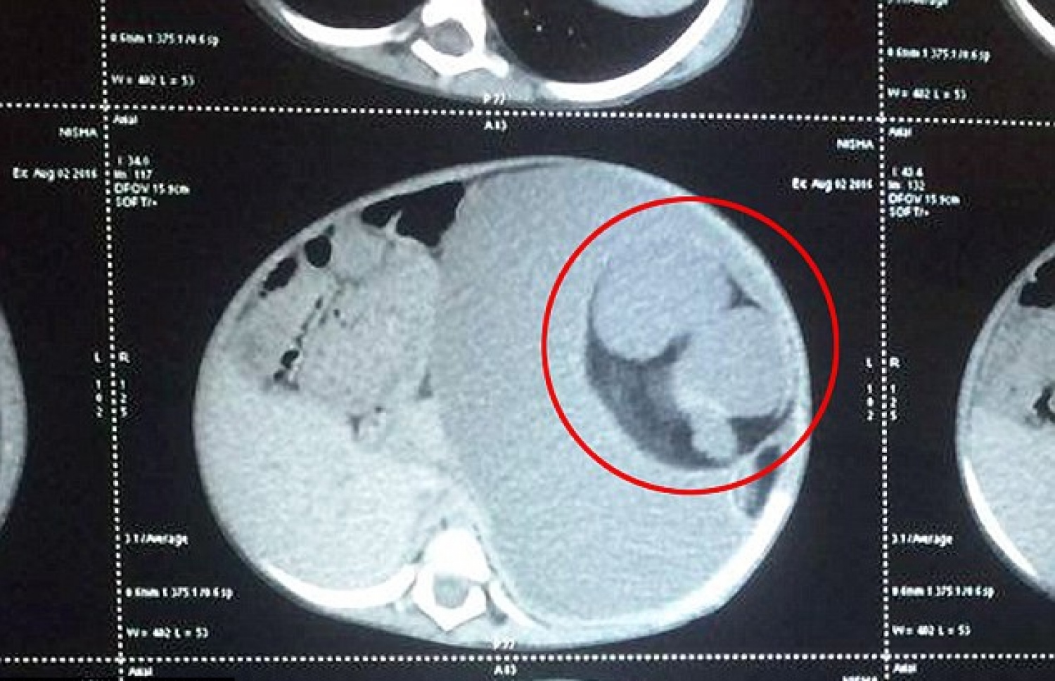 ނިޝާގެ ބަނޑުގެ ސްކޭނުން ބަނޑުގައި އޮތް ކުއްޖާ ފާހަގަކޮށްފައި