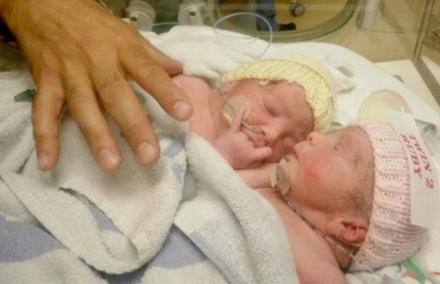 އިނގިރޭސިވިލާތުގެ މި ދެ ކުދިން ވިހޭ އިރު ވަނީ އެއް ހަށިގަނޑަކުން ގުޅިފައި. --ފޮޓޯ:ބީބީސީ