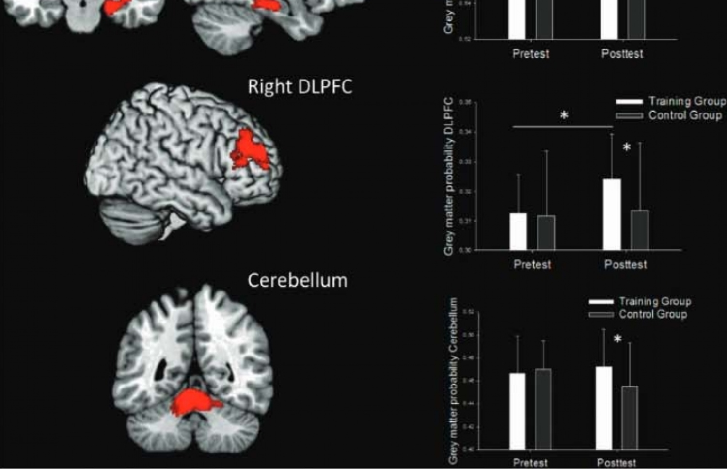 ވީޑިޔޯ ގޭމުން ސިކުނޑިއަށް ކުރާ އަސަރު ބެލުމަށް ނަގާފައިވާ އެމް-އާރް-އައި ސްކޭން - މޮލެކިއުލާ ސައިކިއެޓްރީ