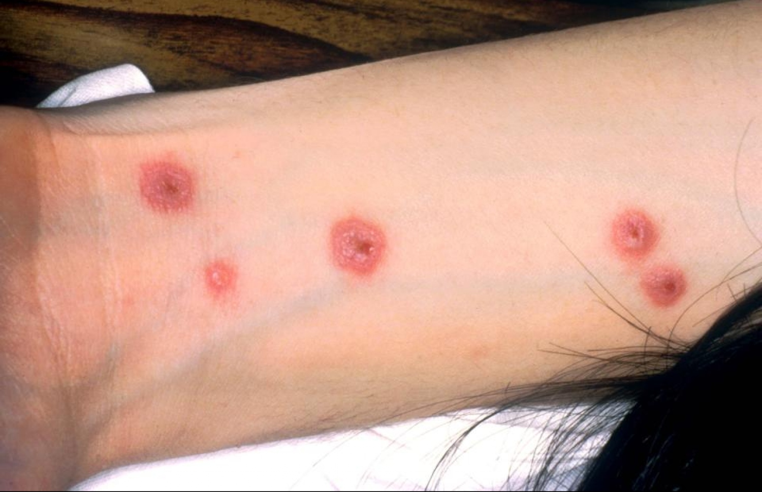 ސްޓީވަންސް ޖޯންސަންސް ސިންޑްރޯމް ޖެހުމުން ނަގާ ބިހިތައް ފުރަތަމަ ހުންނަ ގޮތް