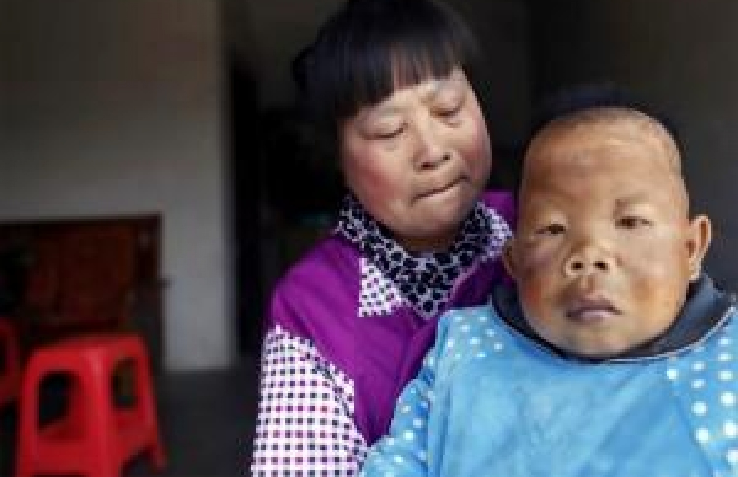 ޗޫގެ ދަރިފުޅަށް ދެ އަހަރުގައި ހެދި ބޮޑުވުން ހުއްޓުނު ސަބަބެއް ޑޮކްޓަރުންނަކަށް ވެސް ނޭނގޭ