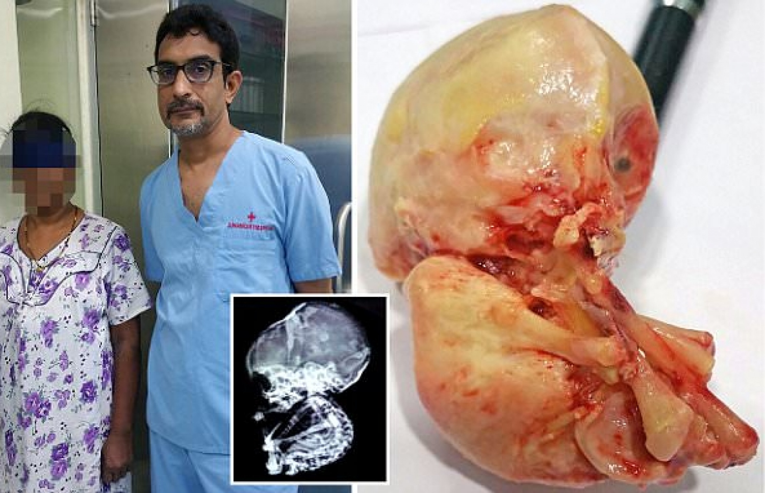 އަންހެންމީހާގެ ބަނޑުން ނެގި ސްޓޯން ބޭބީ (ކ) އަދި އަންހެންމީހާ އާއި އޭނާ އޮޕަރޭޝަން ކޮށްދިން ޑޮކްޓަރު