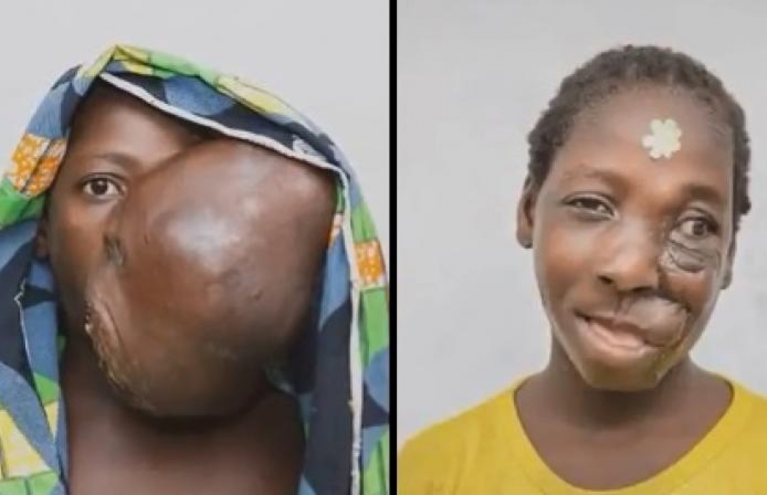 ކަލްތޯމީ އޮޕަރޭޝަނަށް ފަހު ހުރި ގޮތާއި ކުރިން ހުރި ގޮތް.