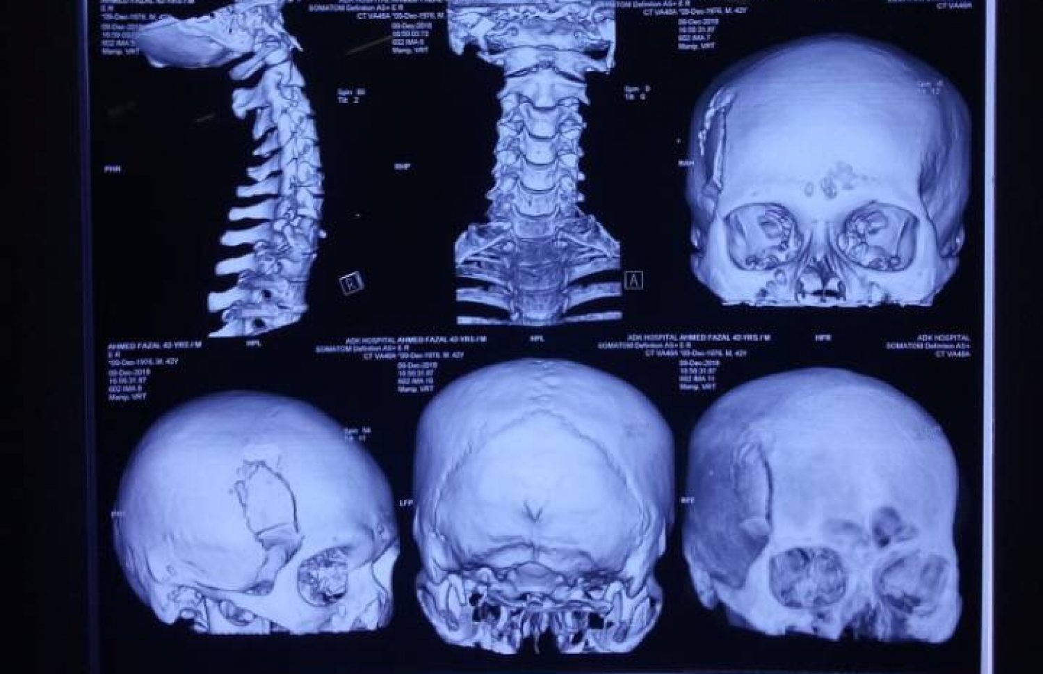 ބްރިޖުގައި އެކްސިޑެންޓުވި ފަޒާލްގެ ބޮލުގެ އެކްސްރޭއެއް: ބްރިޖުގައި ހިނގާ އެކްސިޑެންޓުތައް ގިނަ ކަމުން ކުއްލި ފިޔަވަޅުތަކެއް އެޅުމަށް ފުލުހުން ދަނީ މަސައްކަތް ކުރަމުން -- މިހާރު ފޮޓޯ