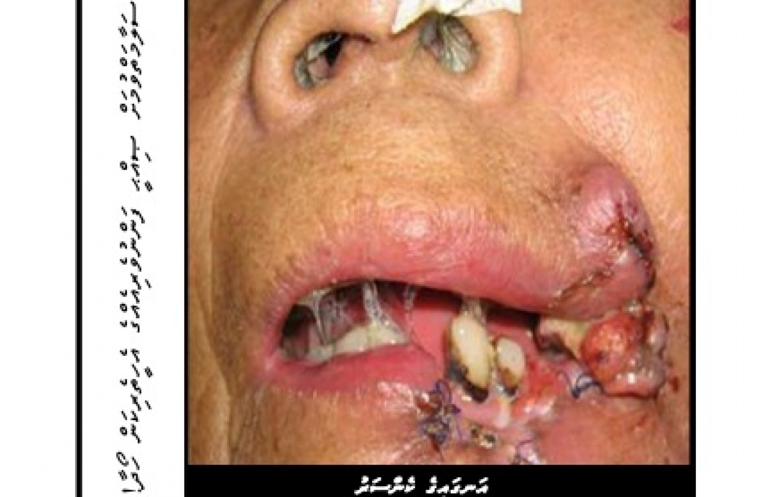 ސިނގިރޭޓު ފޮށީގެ ބޭރުގައި ޖަހަން ނިންމާފައިވާ އިންޒާރުގެ ފޮޓޯ