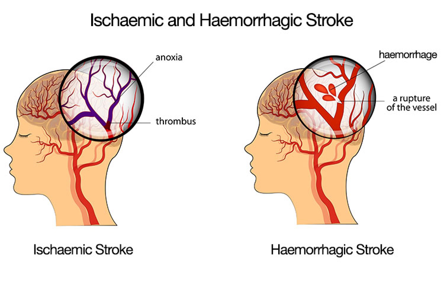 ސްޓޯކްގެ ދެ ވައްތަރު--