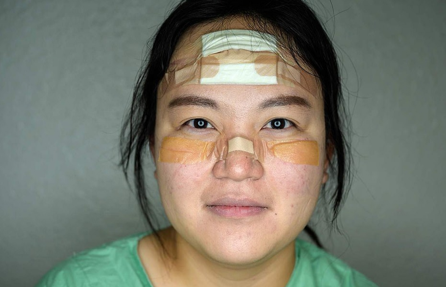 ދެކުނު ކޮރެއާގެ ނަރުހަކު އޭނާގެ ރައްކާތެރިކަމުގެ މާސްކުގެ ސަބަބުން މޫނުން ހަލާކުވެފައިވާ ތަންތަނުގައި ބެންޑޭޖް އަޅާފައި. މި ހާލުގައި ވެސް ކޮންމެ ދުވަހަކު އެ މީހުން ހިދުމަތަށް ނުކުމޭ