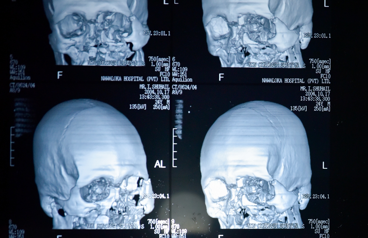 ސުހައިލްގެ މޫނަށް ލިބިފައިވާ ގެއްލުންތައް