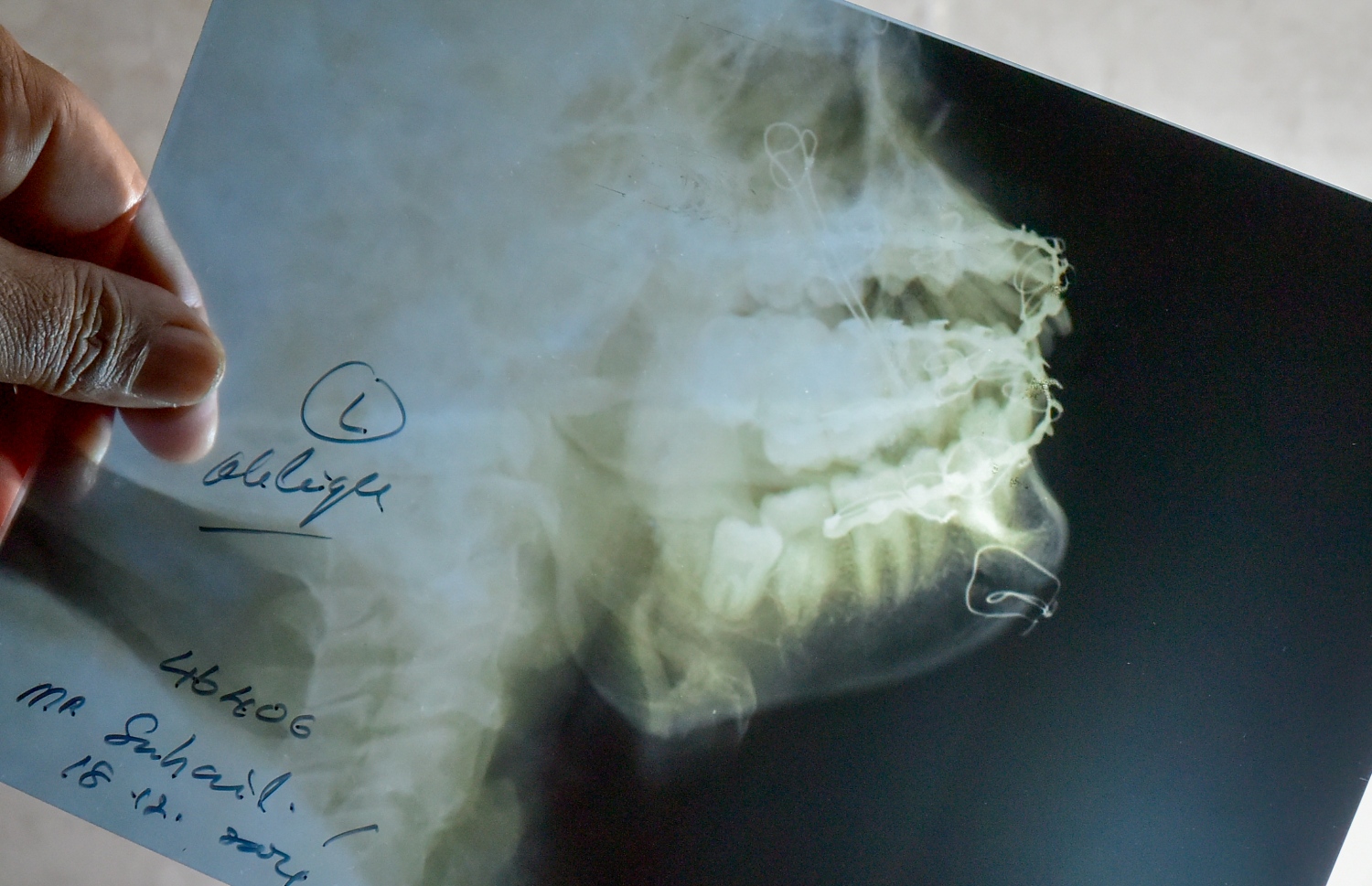 ސުހައިލްގެ ސާޖަރީ އަށް ފަހު އަނގަ އާއި ދަތްތައް ދައްކައިދޭ އެކްސްރޭއެއް