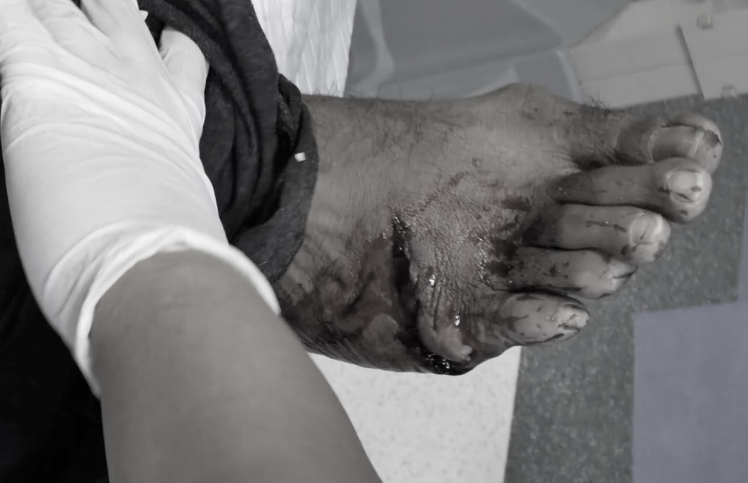 ހަމަލާގައި އެކި މީހުންނަށް ލިބިފައި ވަނީ އެކި ޒަހަމް. މިއީ، އޭގެ ތެރެއިން އެކަކަށް ލިބުނު ޒަހަމް. އޭނާގެ ފައި ކަފައިގެން ގޮސް، ހަށިގަނޑުގެ ބައެއް އެހެން ތަންތަން ވެސް ފުންކޮށް ޒަހަމްވި. އެހެން ބައެއް މީސްމީހުންނާއި ބޮޑީގާޑުންނަށް ވެސް ވަނީ ބޮޑެތި ޒަހަމްތައް ލިބިފައި.