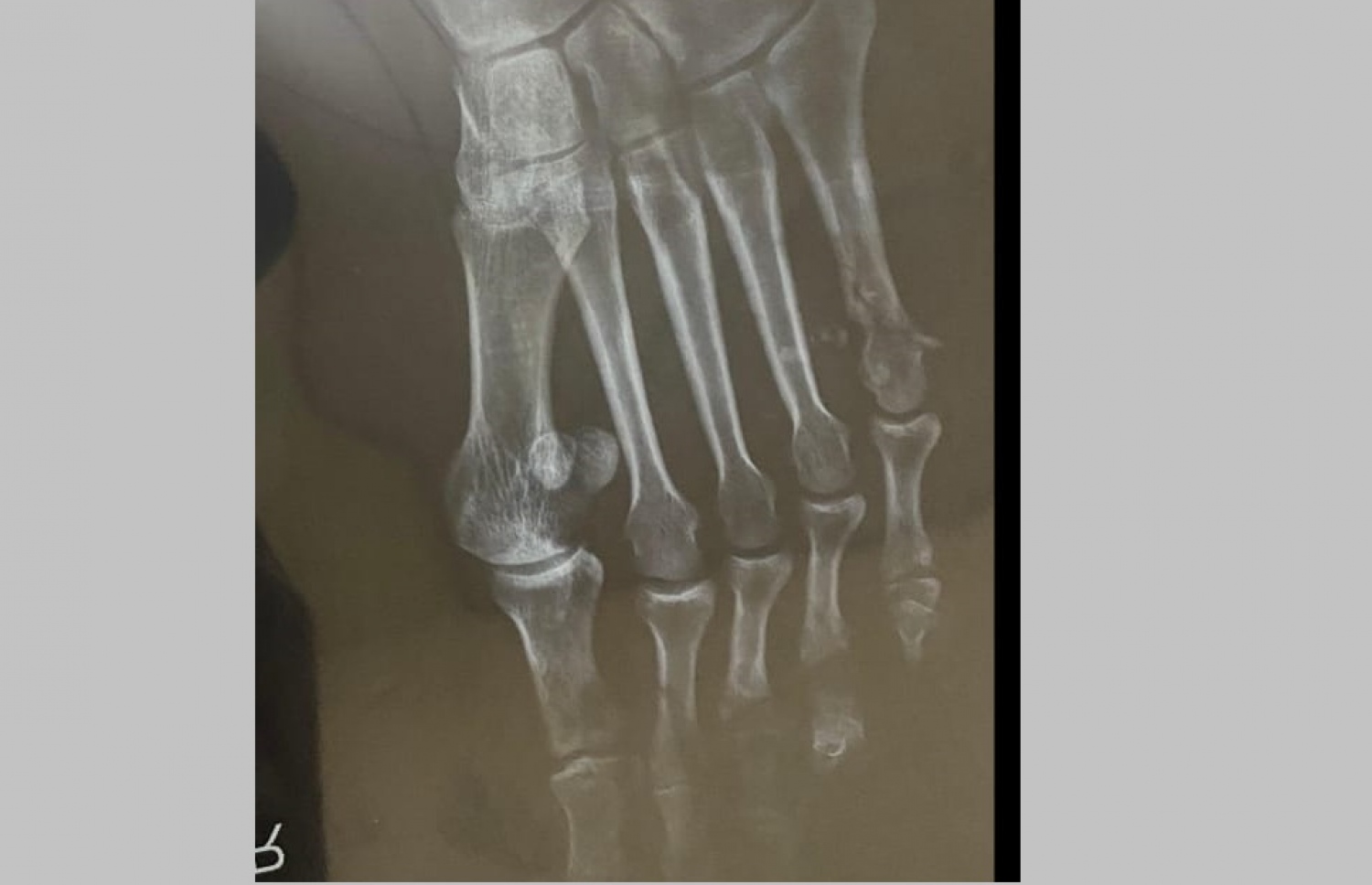 ހަމަލާގައި އާދަމްގެ ފަޔަށް ލިބުނު ގެއްލުން ފެންނަ އެކްސްރޭއެއް.