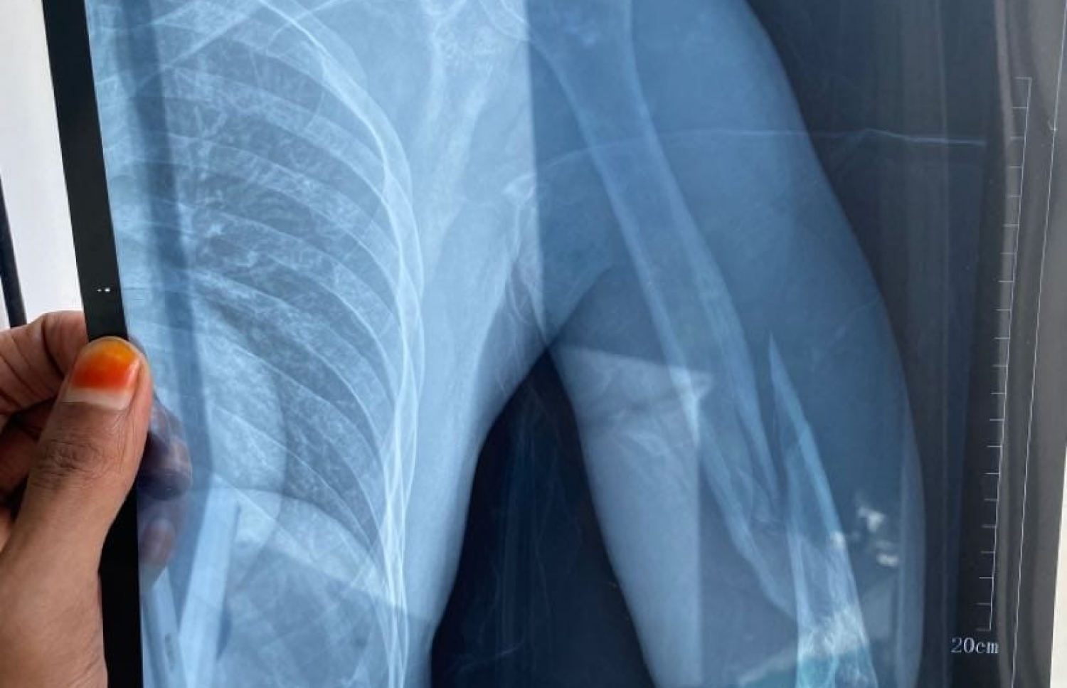 ލަވަކިޔުންތެރިޔާ ފަތޯގެ އަތުގެ އެކްސްރޭ: ވައަތުގެ އުޅަނބޮއްޓާއި ކޮނޑުހުޅާ ދެމެދުން ވަނީ ބިނދިފައި.