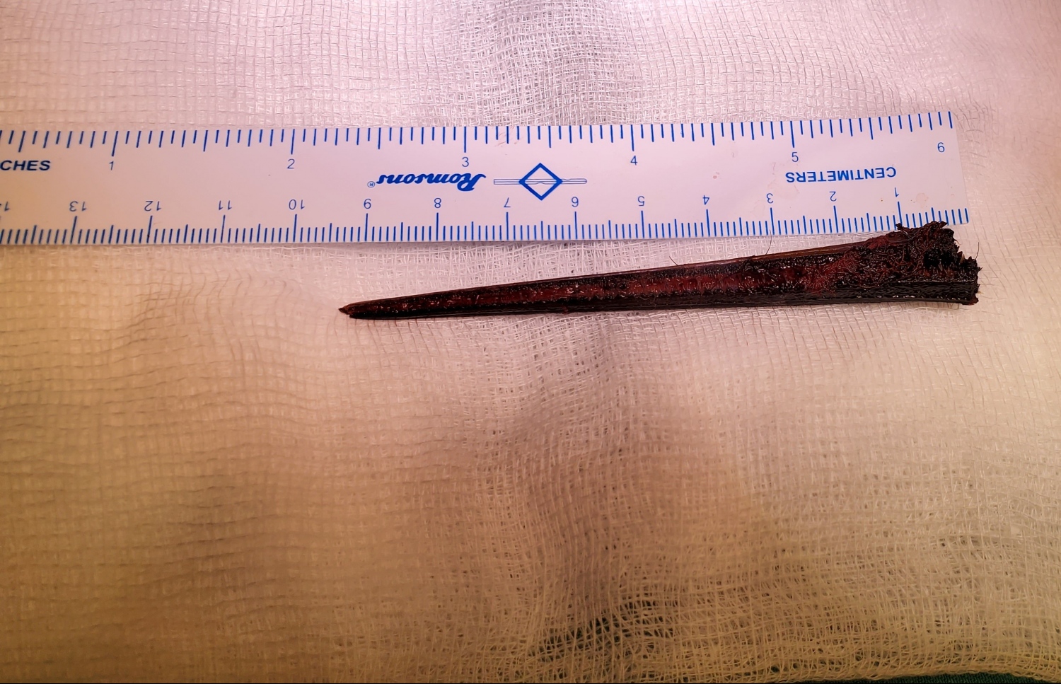 އަނީލްގެ ކަރަށް ހެރުނު ތޮޅީގެ ތުންގަނޑު އޮޕަރޭޝަން ކޮށްގެން ނައިގައި: މީގައި ނުވަ ސެންޓިމީތަރު ހުރި.