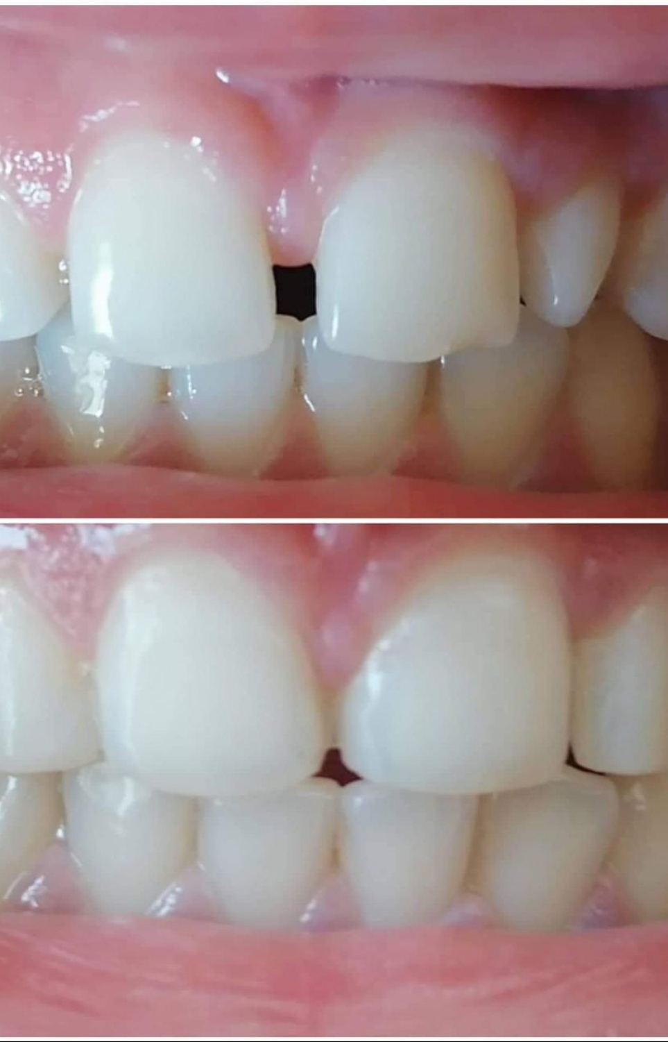 އިފާ، ދަރުވާކޮށް ދުރުކޮށް ހުރި ދެ ދަތް ކައިރިކޮށްފައި.