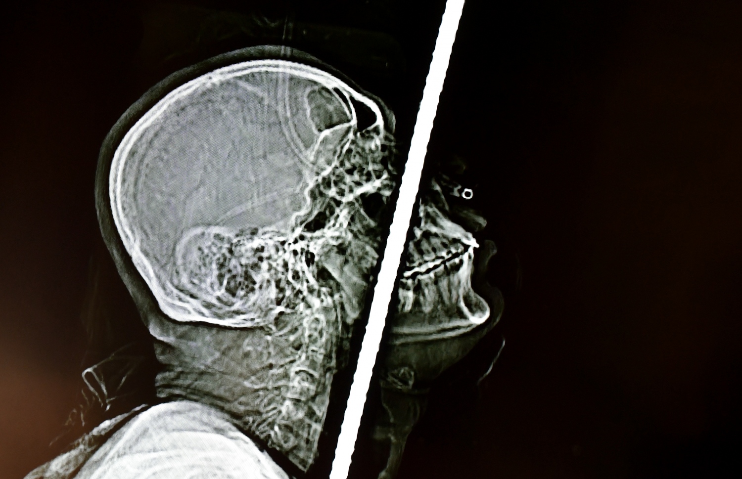 ހަށިގަނޑު ފޫއަޅުވާލައި، ދަގަނޑެއް ވަތް ބިދޭސީ މަސައްކަތު މީހާއާ ގުޅޭ މައުލޫމާތު ދިނުމަށް އޭޑީކޭ ހޮސްޕިޓަލުން ބޭއްވި ނިއުސް ކޮންފަރެންސްގައި ދެއްކި، އެ މީހާގެ ހަށިގަނޑަށް ދަގަނޑު ވަދެފައި އޮތްގޮތް ފެންނަ ގޮތުގެ ސްކޭނެއް -- ފޮޓޯ: ފަޔާޒް މޫސާ | މިހާރު