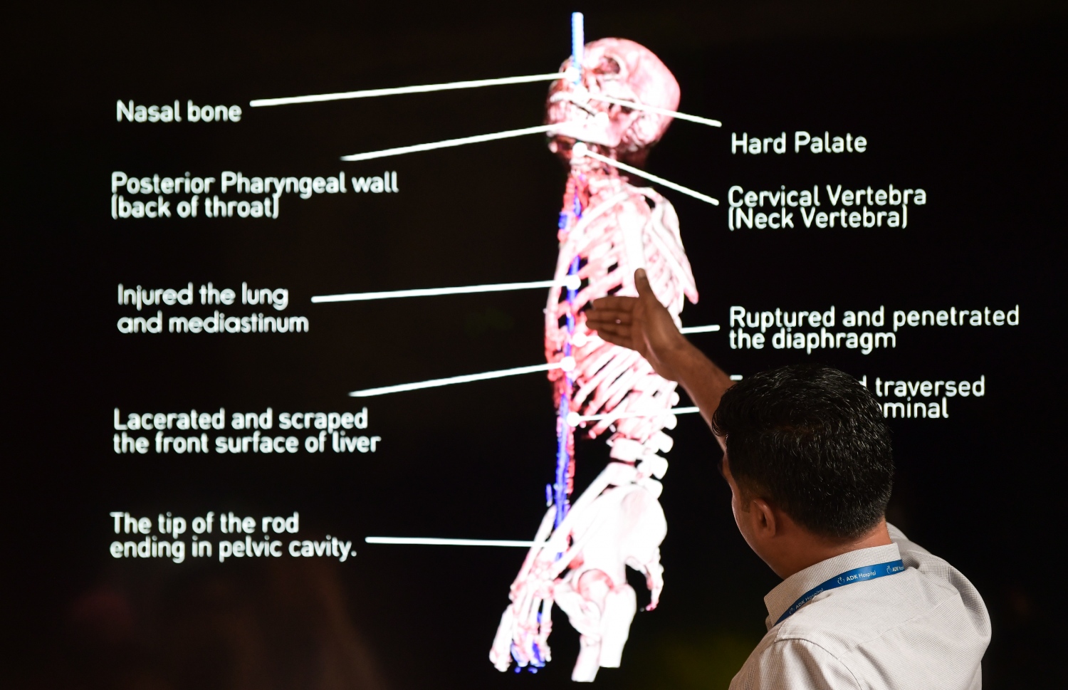 ހަށިގަނޑު ފޫއަޅުވާލައި، ދަގަނޑެއް ވަތް ބިދޭސީ މަސައްކަތު މީހާއާ ގުޅޭ މައުލޫމާތު ދިނުމަށް އޭޑީކޭ ހޮސްޕިޓަލުން ބޭއްވި ނިއުސް ކޮންފަރެންސްގައި ދެއްކި، އެ މީހާގެ ހަށިގަނޑަށް ދަގަނޑު ވަދެފައި އޮތްގޮތް ޑޮކްޓަރަކު ދައްކަނީ -- ފޮޓޯ: ފަޔާޒް މޫސާ | މިހާރު