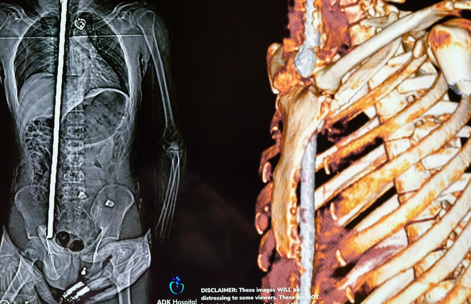 ހަށިގަނޑު ފޫއަޅުވާލައި، ދަގަނޑެއް ވަތް ބިދޭސީ މަސައްކަތު މީހާއާ ގުޅޭ މައުލޫމާތު ދިނުމަށް އޭޑީކޭ ހޮސްޕިޓަލުން ބޭއްވި ނިއުސް ކޮންފަރެންސްގައި ދެއްކި، އެ މީހާގެ ހަށިގަނޑަށް ދަގަނޑު ވަދެފައި އޮތްގޮތް ފެންނަ ގޮތުގެ ސްކޭނަކާއި ތުރީޑީ ފޮޓޯއެއް -- ފޮޓޯ: ފަޔާޒް މޫސާ | މިހާރު