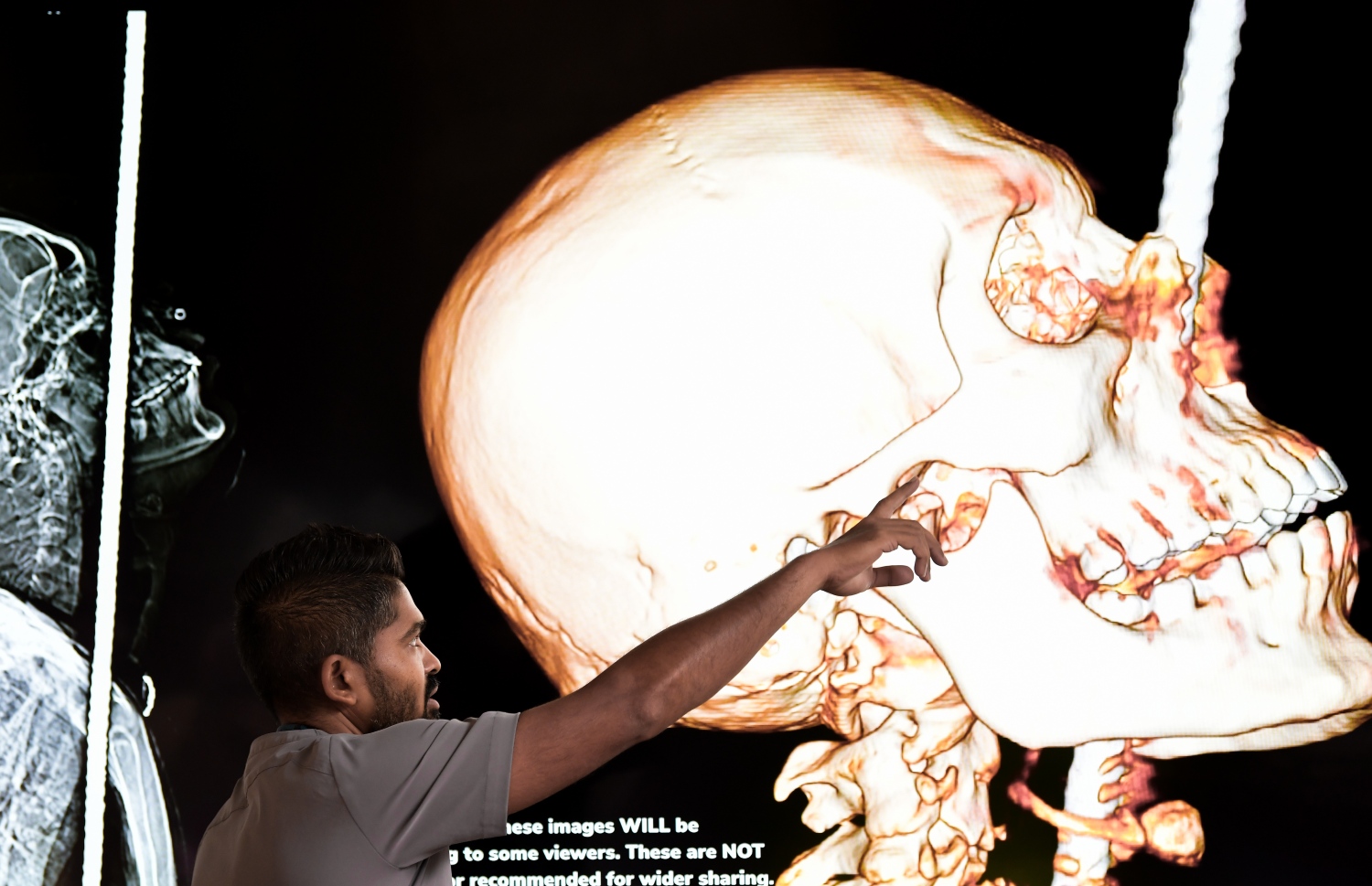 ހަށިގަނޑު ފޫއަޅުވާލައި، ދަގަނޑެއް ވަތް ބިދޭސީ މަސައްކަތު މީހާއާ ގުޅޭ މައުލޫމާތު ދިނުމަށް އޭޑީކޭ ހޮސްޕިޓަލުން ބޭއްވި ނިއުސް ކޮންފަރެންސްގައި ދެއްކި، އެ މީހާގެ ހަށިގަނޑަށް ދަގަނޑު ވަދެފައި އޮތްގޮތް ފެންނަ ގޮތުގެ ތުރީޑީ ފޮޓޯއެއް ދައްކާލަނީ -- ފޮޓޯ: ފަޔާޒް މޫސާ | މިހާރު