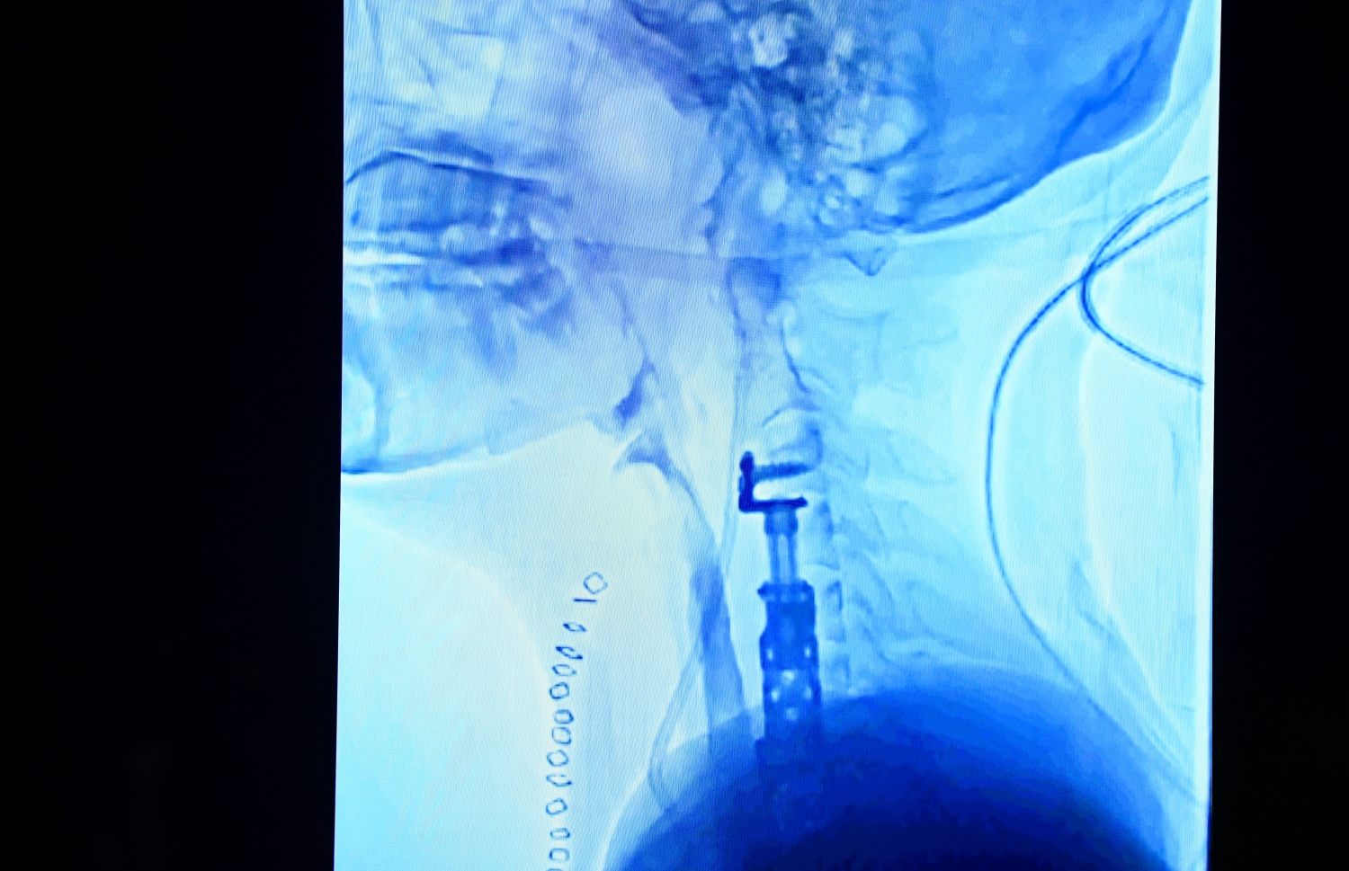 ހަށިގަނޑު ފޫއަޅުވާލައި، ދަގަނޑެއް ވަތް ބިދޭސީ މަސައްކަތު މީހާއާ ގުޅޭ މައުލޫމާތު ދިނުމަށް އޭޑީކޭ ހޮސްޕިޓަލުން ބޭއްވި ނިއުސް ކޮންފަރެންސްގައި ދެއްކި، އޭނާގެ ކަރުން މަތީގެ ސްކޭނެއް -- ފޮޓޯ: ފަޔާޒް މޫސާ | މިހާރު