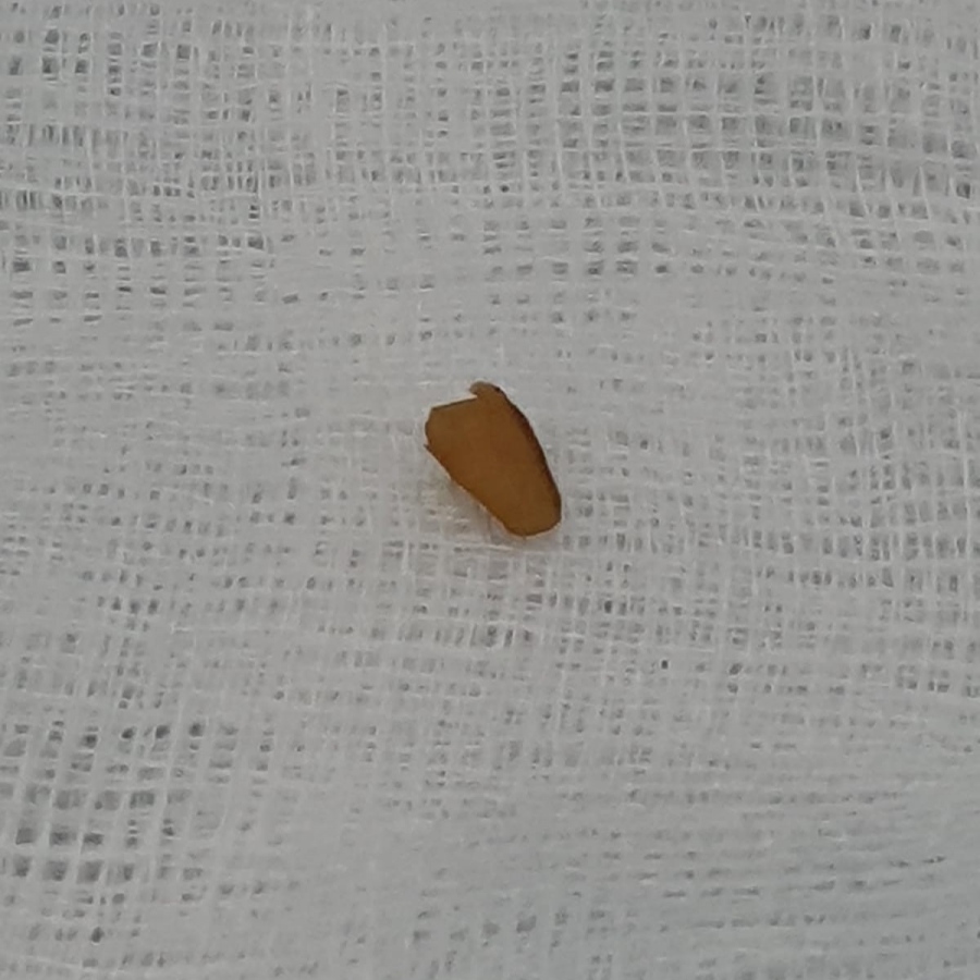 މީގެ 20 އަހަރު ކުރިން މީހެއްގެ ސައިންސްގެ ތެރެއަށް ދިޔަ ދަތުގެ ބައި، އޮޕަރޭޝަން ކޮށްގެން ނަގައިފައި. -- ފޮޓޯ: އޭއީއެޗް