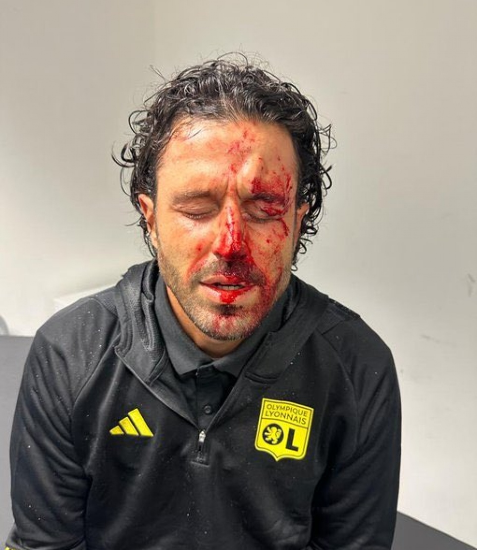 މާސޭގެ ސަޕޯޓަރުންގެ ހަމަލާތަކުގައި ލިޔޯންގެ ކޯޗު ގްރޯސޯގެ މޫނު ވަނީ ވަރަށް ބޮޑަށް ޒަހަމް ވެފައި.--