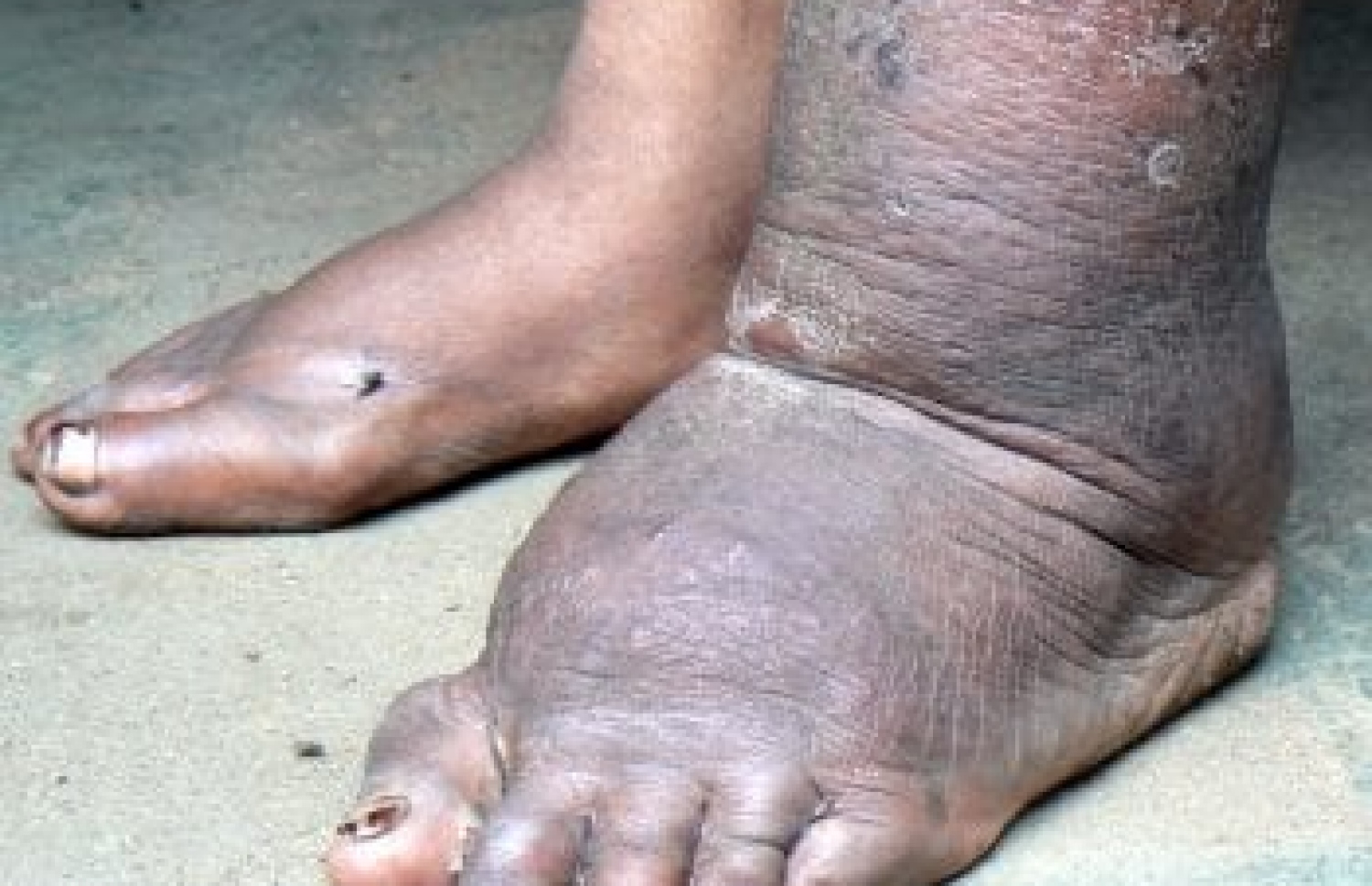 ފައިލޭރިއާ ޖެހިފައިވާ މީހެއްގެ ފައި ދުޅަވެފައި: މި ހާލަތަށް ދާ ފަހުން ފައިލޭރިއާ ހުރިކަން ދެނެގަނެވި، ބޭސް ކާން ފެށިއަސް، ރަނގަޅެއް ނުވާނެ.