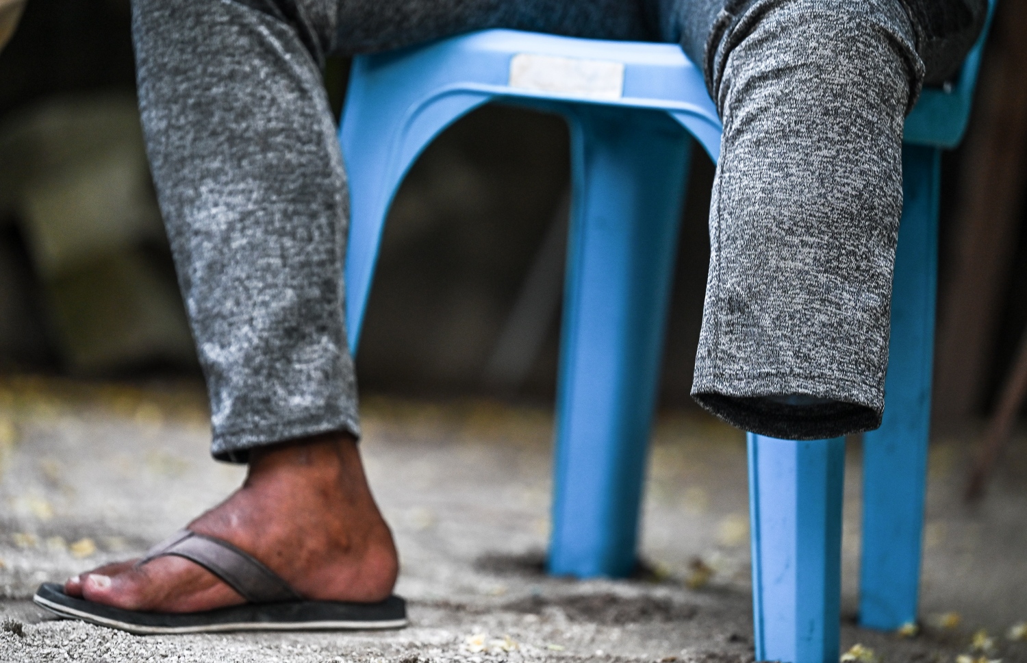 އެކްސިޑެންޓުގައި އިބްރާހިމް މުހައްމަދަށް ލިބުނު އަނިޔާގެ ސަބަބުން އެއް ފައި ބުރިކޮށްލާފައި: މި ހާލުގައި ޖެހުނު އިރު އެކްސިޑެންޓުވި ގޮތެއް އަދި އެކަމުގައި ހިމެނެނީ ކޮން ބައެއް ކަމެއް ވެސް އޭނާއަކަށް ނޭނގެ. -- ފޮޓޯ: ފަޔާޒް މޫސާ | މިހާރު