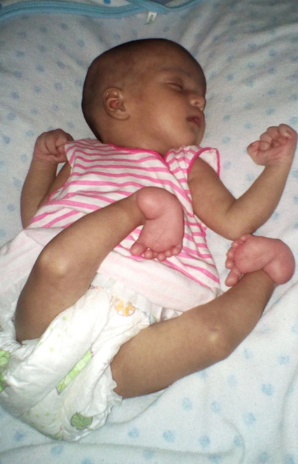 އޮޕަރޭޝަންގެ ކުރިން ނުސައިބާގެ ފައި އިން ގޮތް.