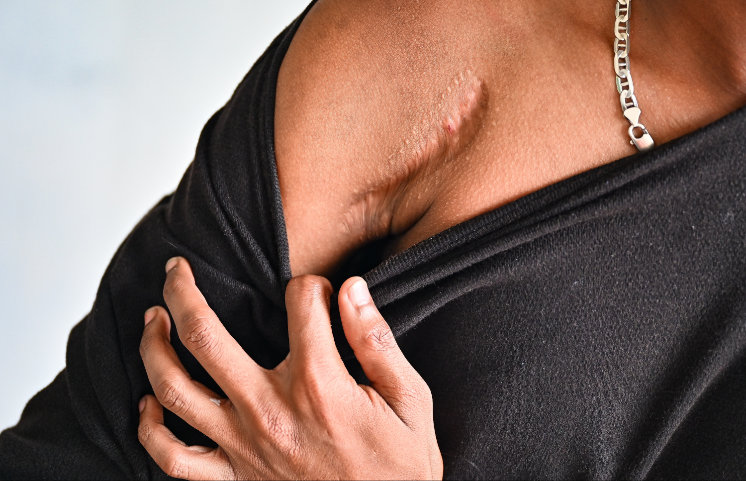 ކޮންކްރީޓުގަނޑު ވެއްޓި ލިބުނު އަނިޔާގައި މުހައްމަދު ފިރުޝާންގެ ކޮނޑުހުޅަށް ލިބުނު އަނިޔާ: އެ ހާދިސާގައި ކޮނޑުހުޅު ބިންދައިގެން ދިޔަ.-- ފޮޓޯ: ފަޔާޒް މޫސާ | މިހާރު