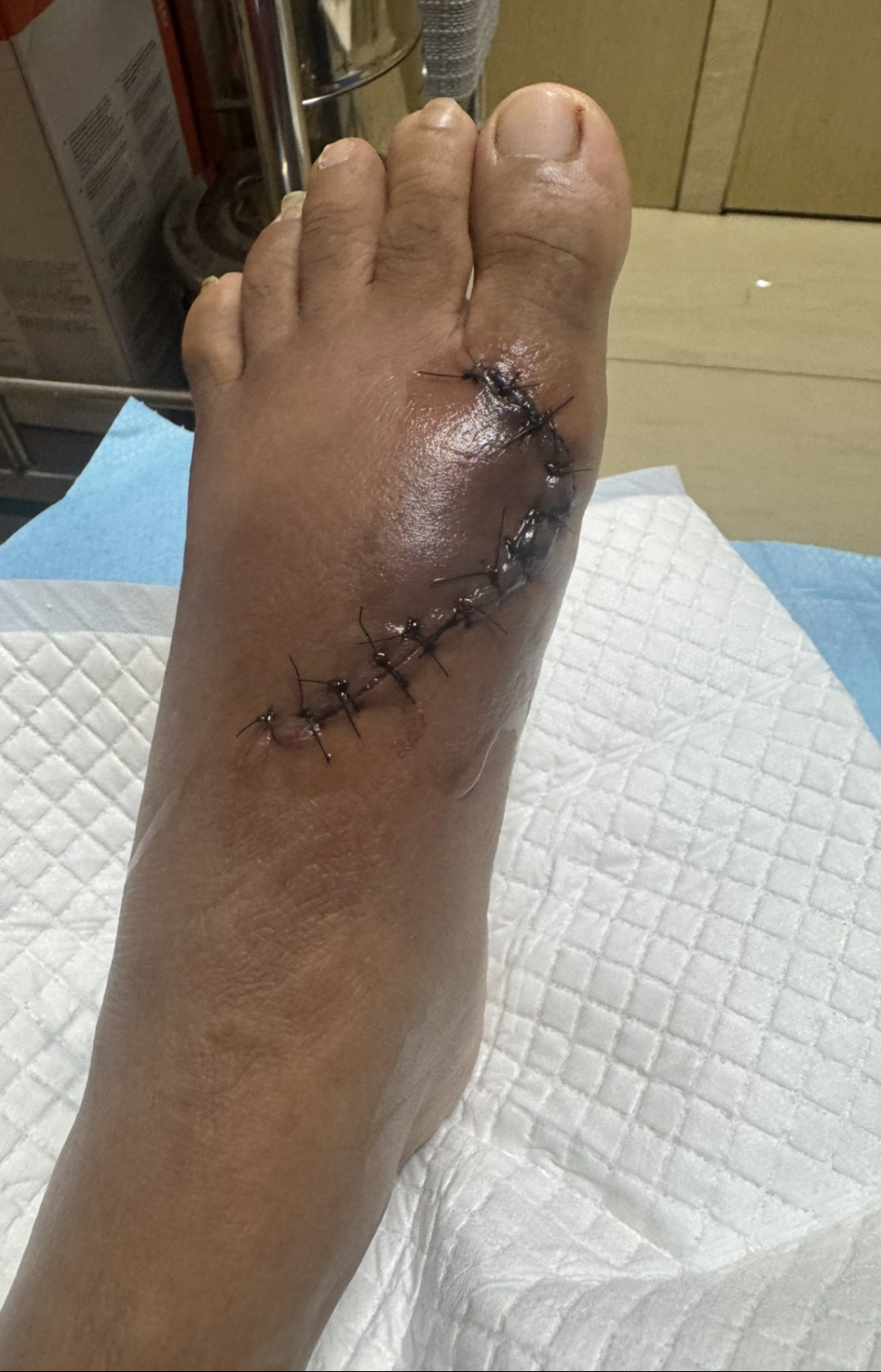 އައިޝާގެ ފައި ކަނޑައިގެން ދިއުމުން ފަހާފައި.