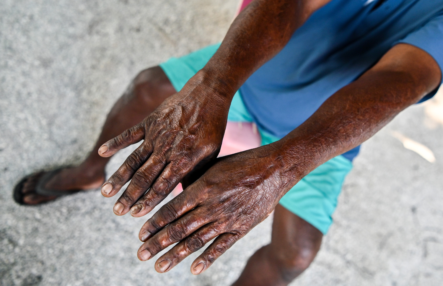 ރޯވި ހާދިސާގައި ލިބުނު އަނިޔާތައް، ޔޫނުސް ދައްކާލަނީ.-- ފޮޓޯ: ފަޔާޒު މޫސާ/ މިހާރު