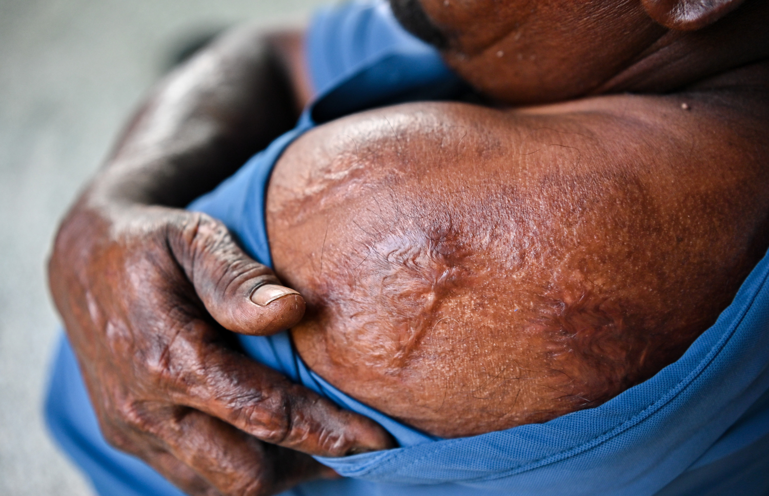 ތިލަފުށީ ބަނދަރުގައި މީގެ 12 އަހަރުކުރިން ހިނގި ހާދިސާގައި ސަލާމަތްވި ޔޫނުސްގެ ހަށިގަނޑަށް ލިބިފައިވާ ގެއްލުންތައް ދައްކާލަނީ.-- ފޮޓޯ: ފަޔާޒު މޫސާ/ މިހާރު