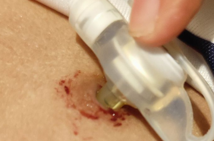 Feeding tube eh nulibi 8 mas, kujjaku maruvi massala balanee